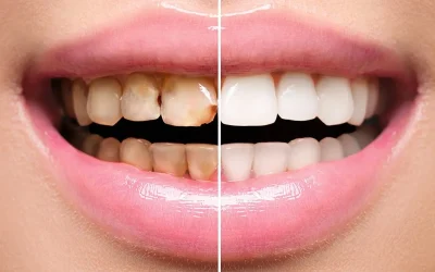 teeth-before-and-after-1920w