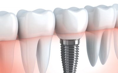 virtual-dental-implant-pmd8o4p0ex3avpxu7nvjvpgd4q2i2431l4hhfqktjc